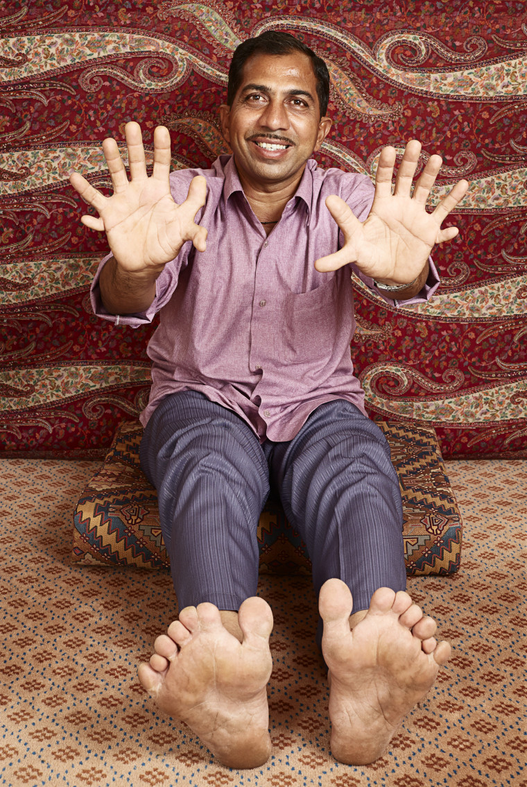 Devendra Suthar - Most Fingers &amp; Toes
Guinness World Records 2015
Photo Credit: Ranald Mackechnie/Guinness World Records